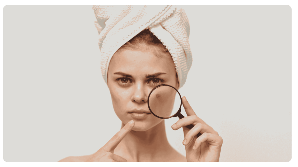 girl with acne face