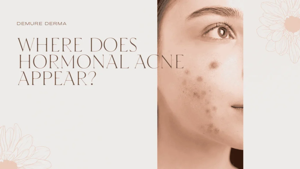 Where Does Hormonal Acne Appear?